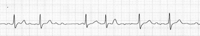 Cardiac Conduction System
