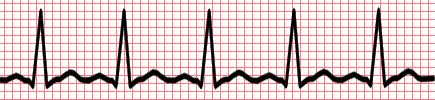 Permanent Pacemaker