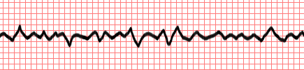 Permanent Pacemaker